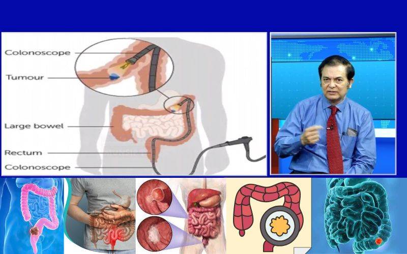 بڑی آنت کا (کولوریکٹل )کینسر: خاموش بیماری، بروقت تشخیص سےعلاج ممکن 